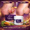 anti fungal before after.webp